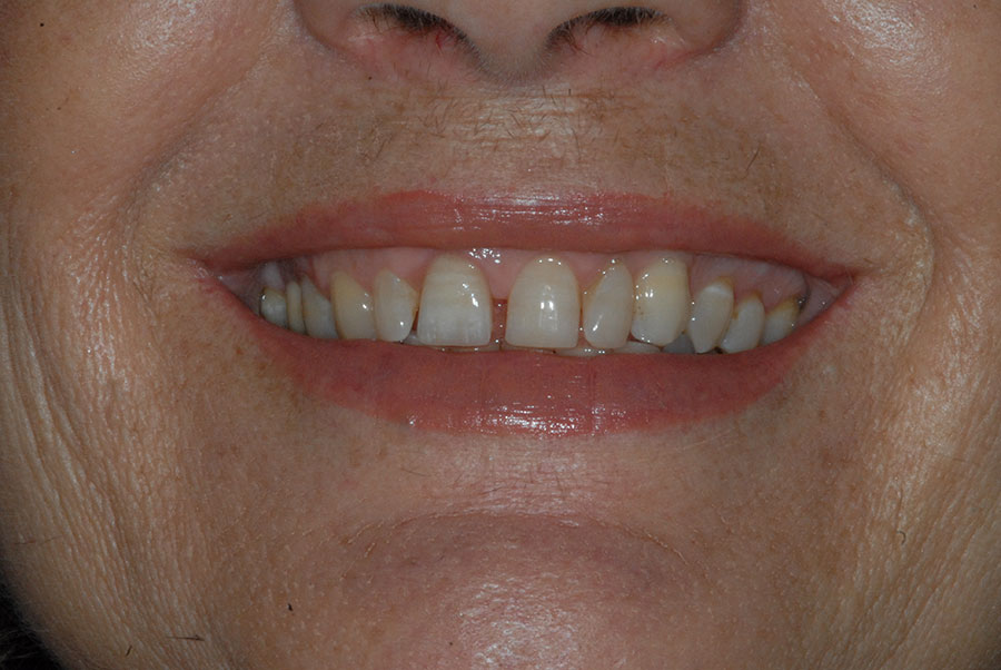 Anna e il suo nuovo incisivo