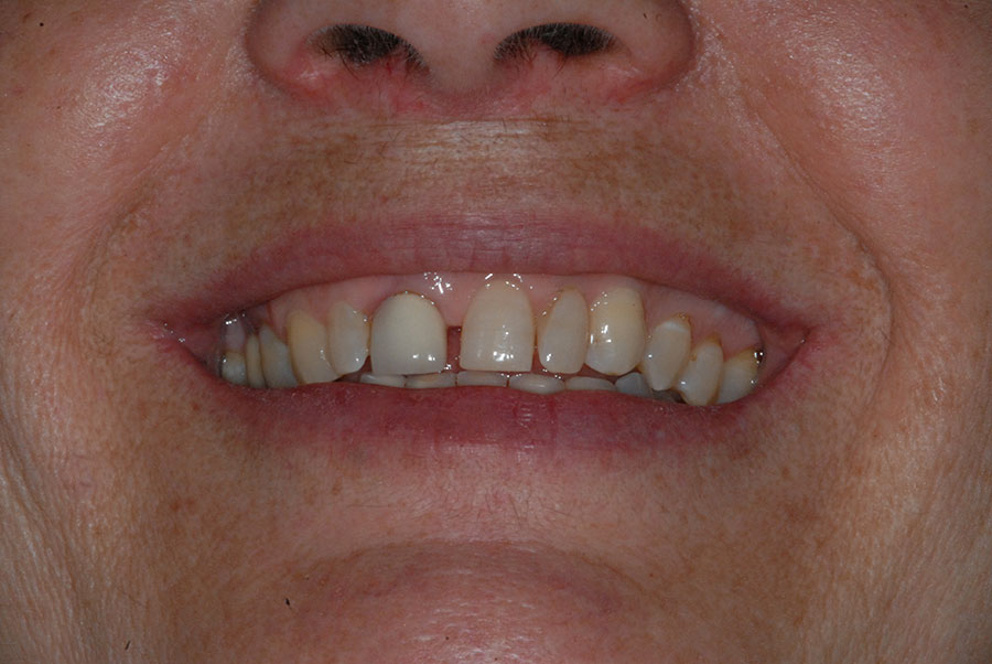 Anna e il suo vecchio incisivo