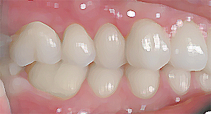 caso studio dentista paoletti zirconio