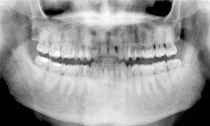 ortopantomografia o panoramica dentale 